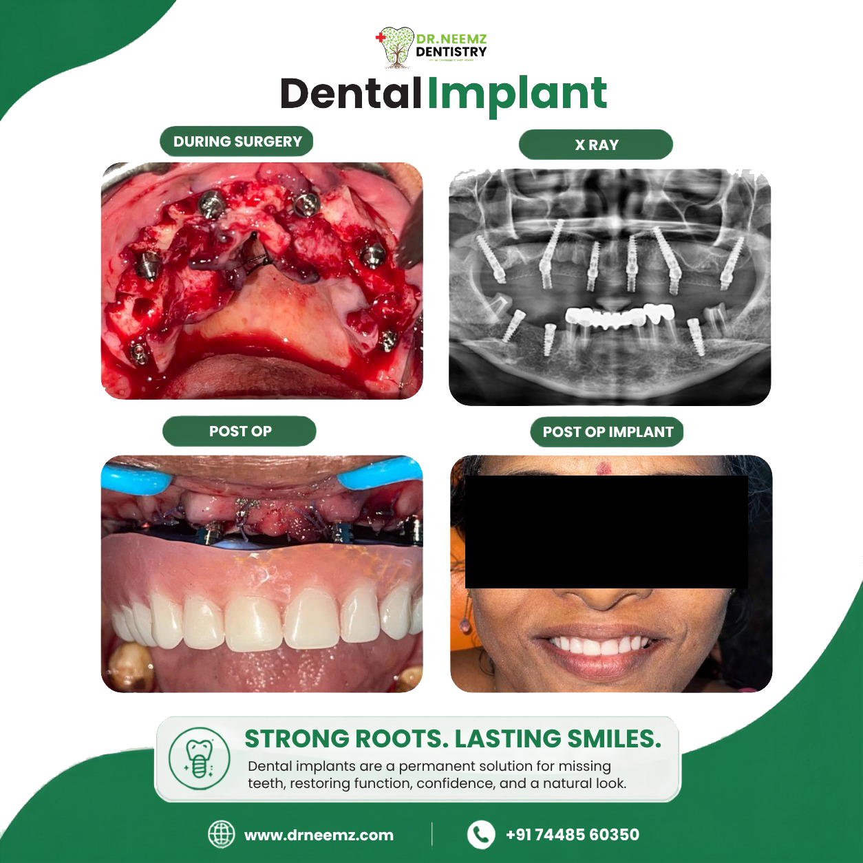 Implants Treatment before & after