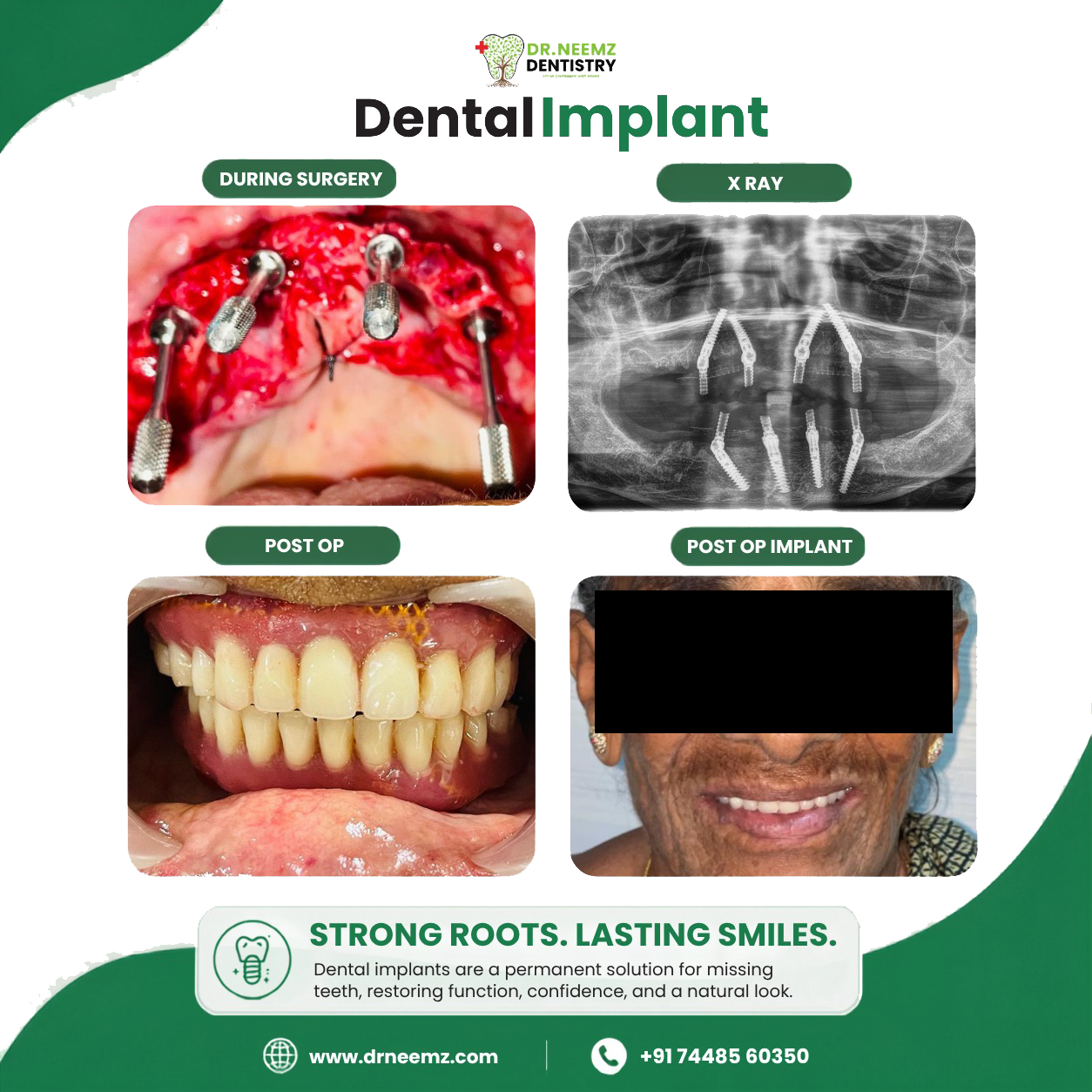 Implants Treatment before & after
