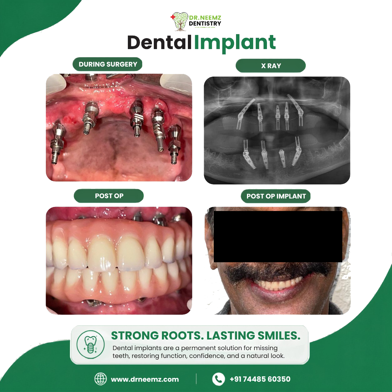 Implants Treatment before & after